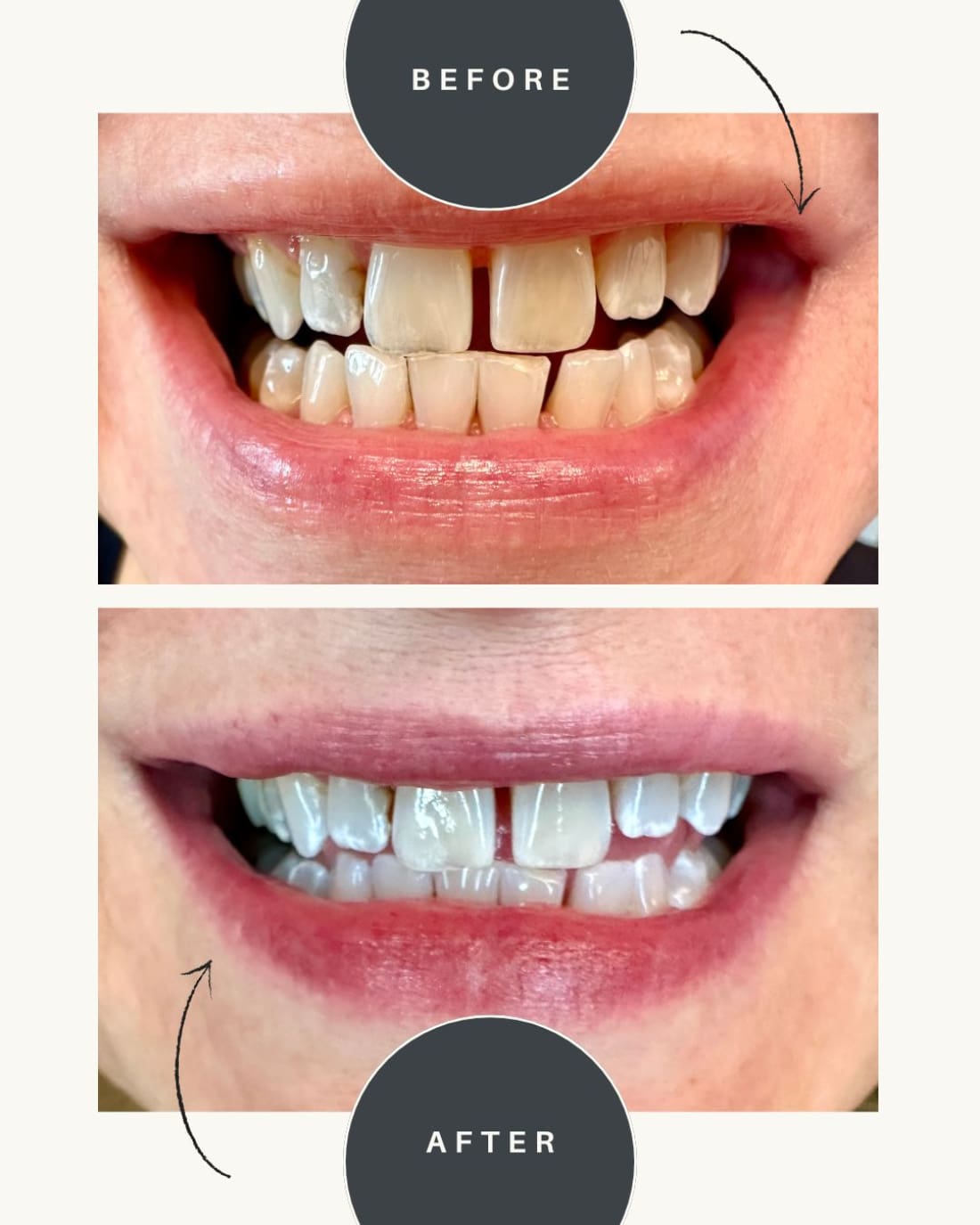 The Best Teeth Whitening Kit