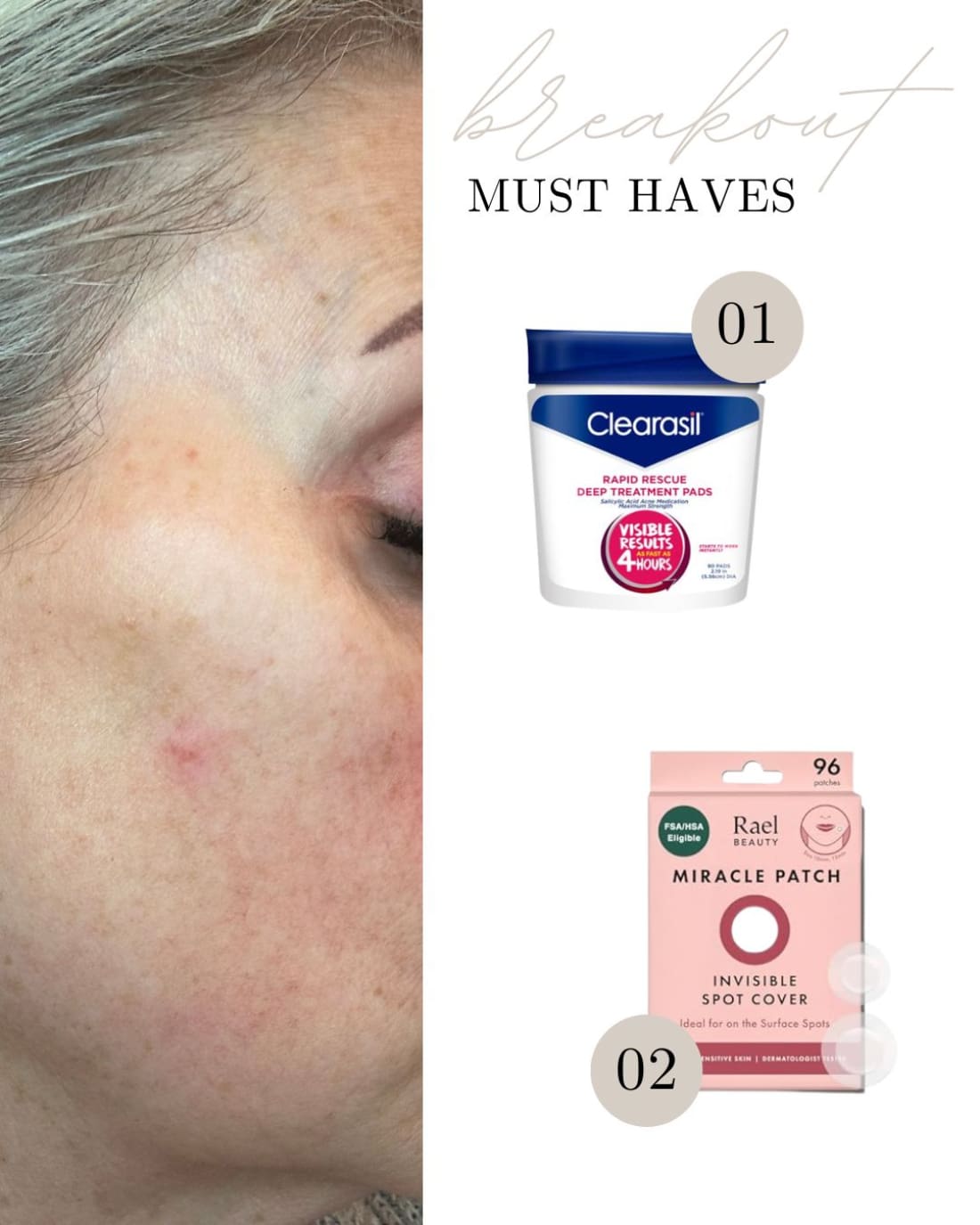 Treat Pimples Fast
